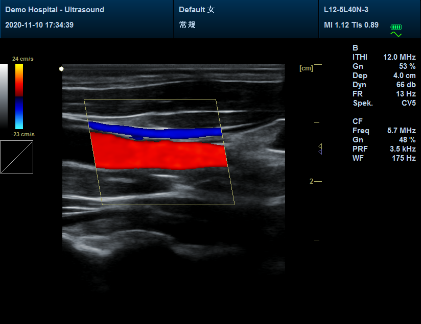 RR1700A Portable Color Doppler Ultrasound Scanner Machine+ Probe