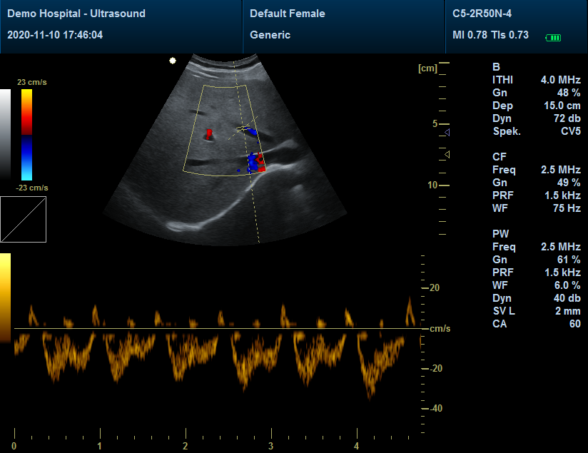 RR1700A Portable Color Doppler Ultrasound Scanner Machine+ Probe